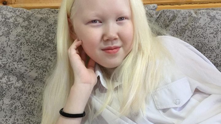 Белые вороны среди людей: как живут и чего боятся дети-альбиносы