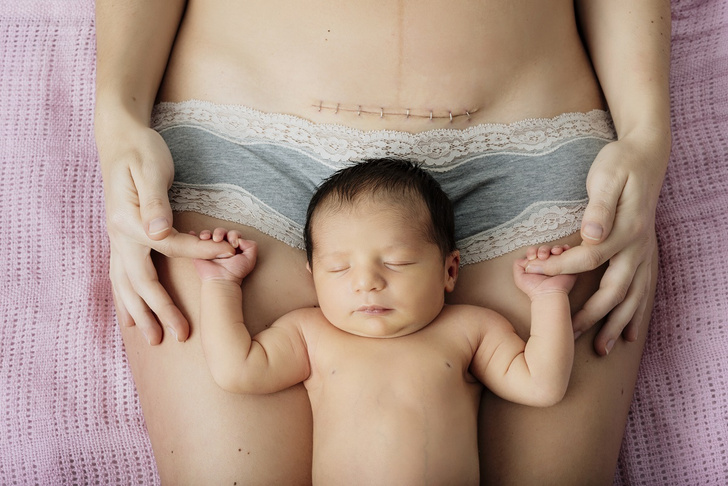 Кесарево сечение: 10 вещей, которые о нем стоит знать каждой маме